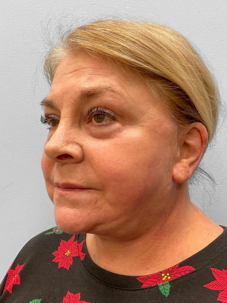 After Image: Facelift & Laser Resurfacing – Dr. Tucker - left-front-oblique