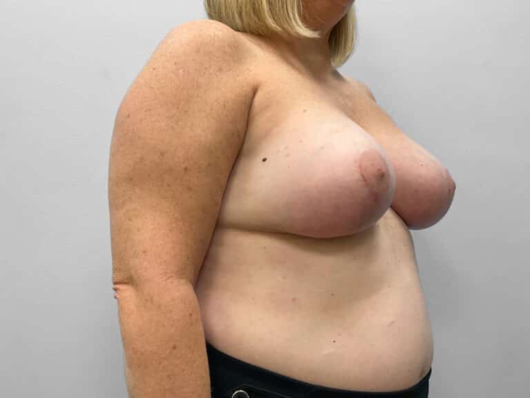 After Image: Breast Augmentation & Lift – Dr. Tucker - right-front-oblique