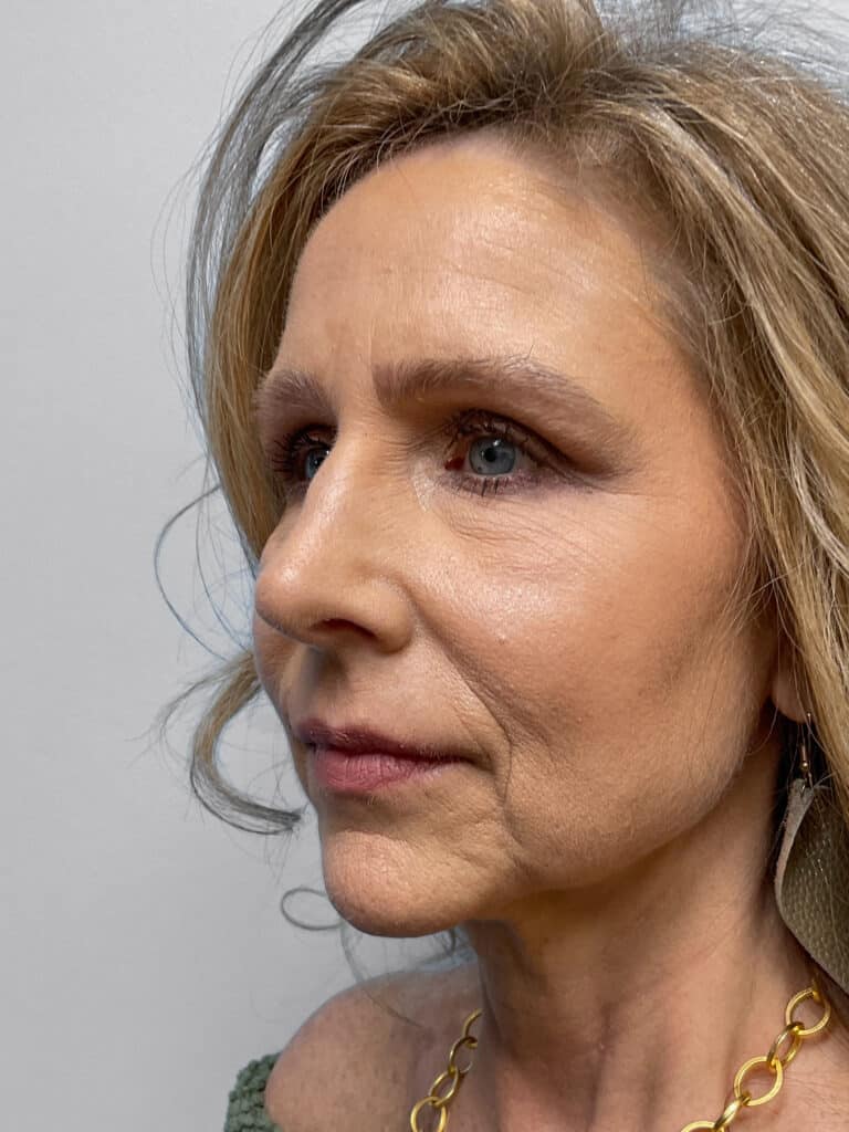After Image: Rhinoplasty – Dr. Tucker - left-front-oblique