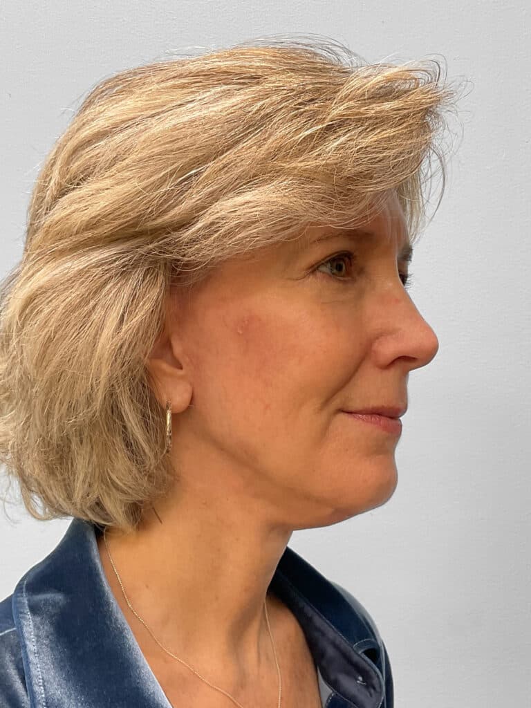 After Image: Facelift & Blepharoplasty – Dr. Tucker - right-front-oblique