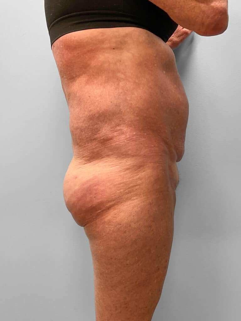 After Image: BBL & Lipo – Dr. Tucker - right-side