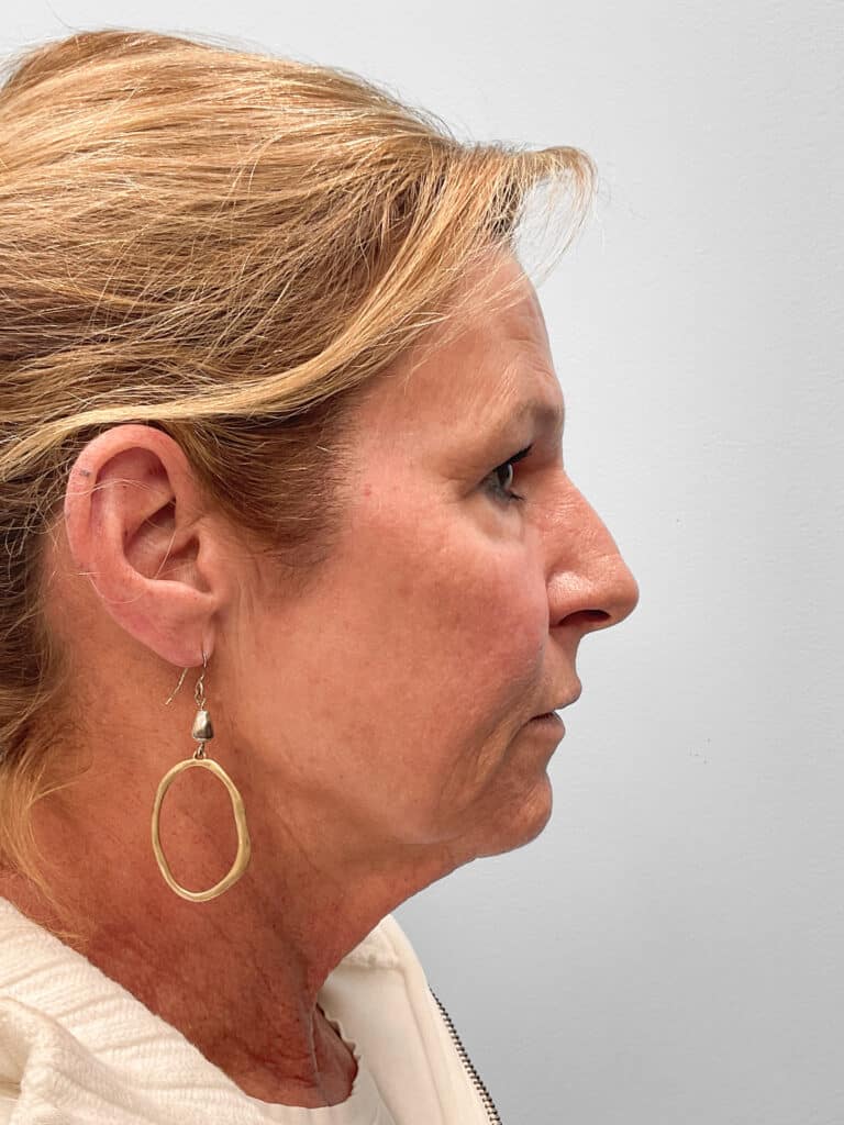 After Image: Laser Resurfacing – Dr. Tucker - right-side