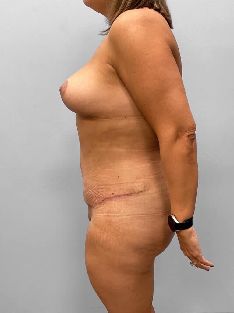 After Image: Mommy Makeover – Dr. Tucker - left-side