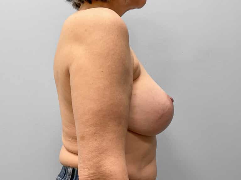 After Image: Breast Implant Exchange – Dr. Tucker - right-side