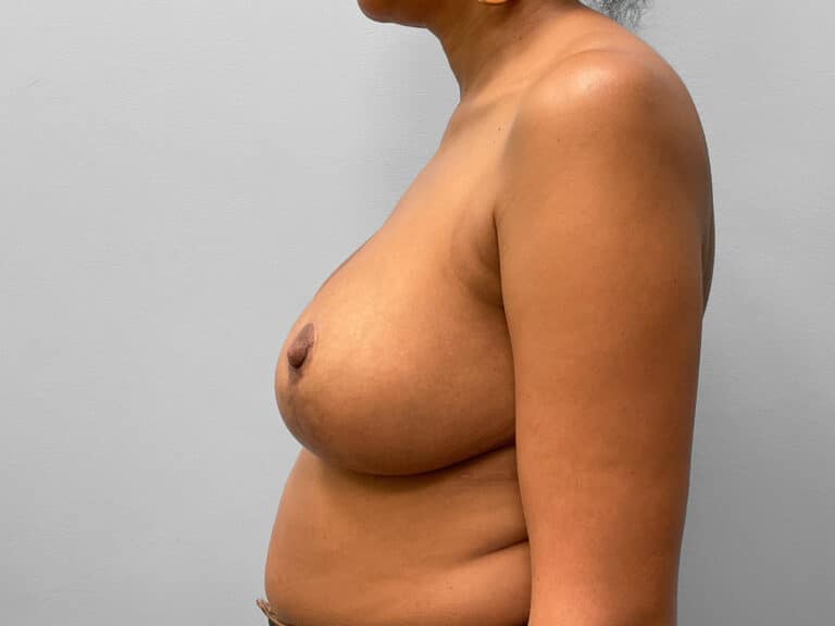 After Image: Breast Reduction – Dr. Tucker - left-side