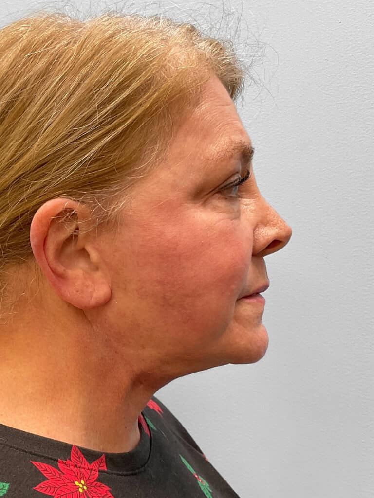 After Image: Facelift & Laser Resurfacing – Dr. Tucker - right-side