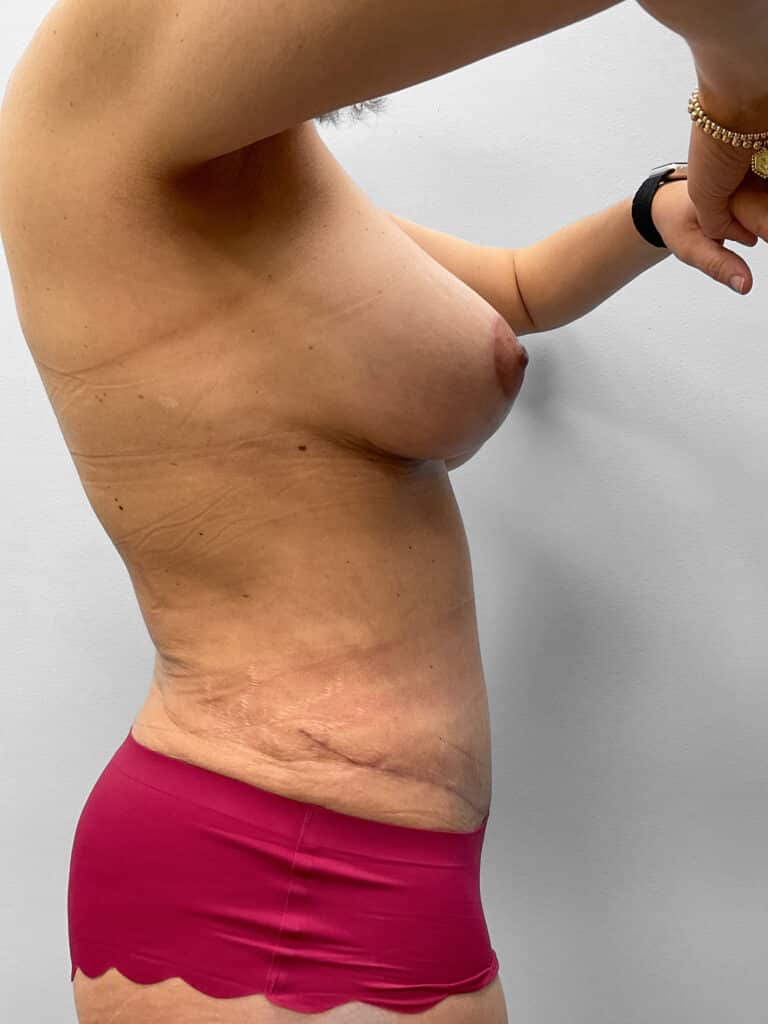 After Image: Mommy Makeover – Dr. Tucker - right-side