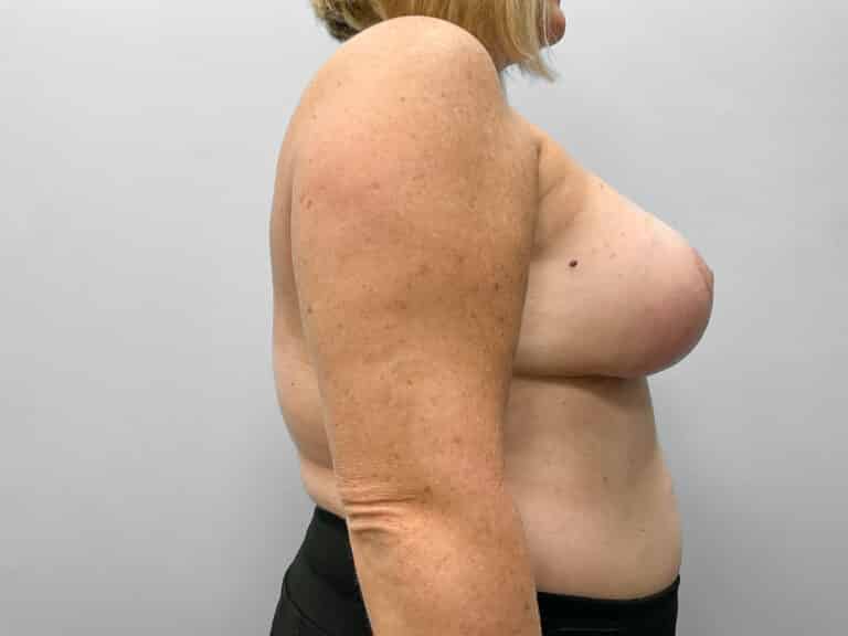 After Image: Breast Augmentation & Lift – Dr. Tucker - right-side