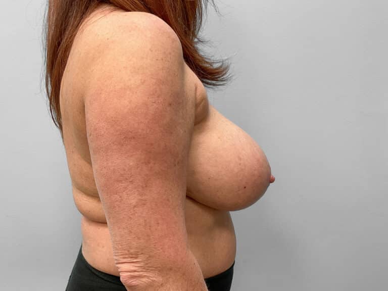 After Image: Breast Implant Exchange – Dr. Tucker - right-side