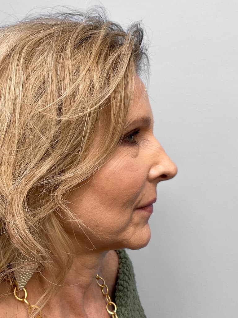 After Image: Rhinoplasty – Dr. Tucker -