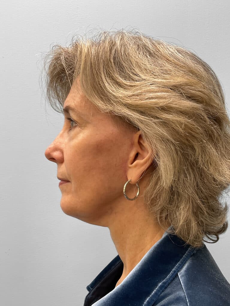 After Image: Facelift & Blepharoplasty – Dr. Tucker - left-side