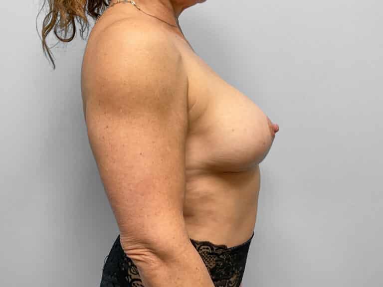 After Image: Breast Augmentation – Dr. Tucker - right-side