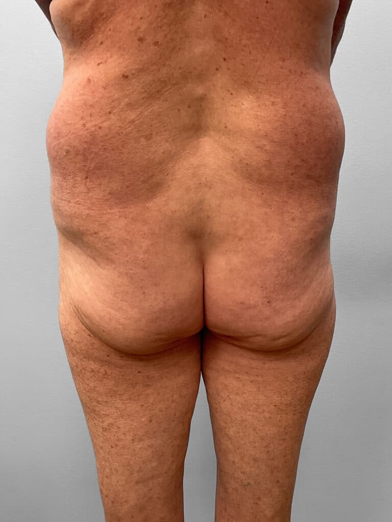 Before Image: BBL & Lipo – Dr. Tucker - back