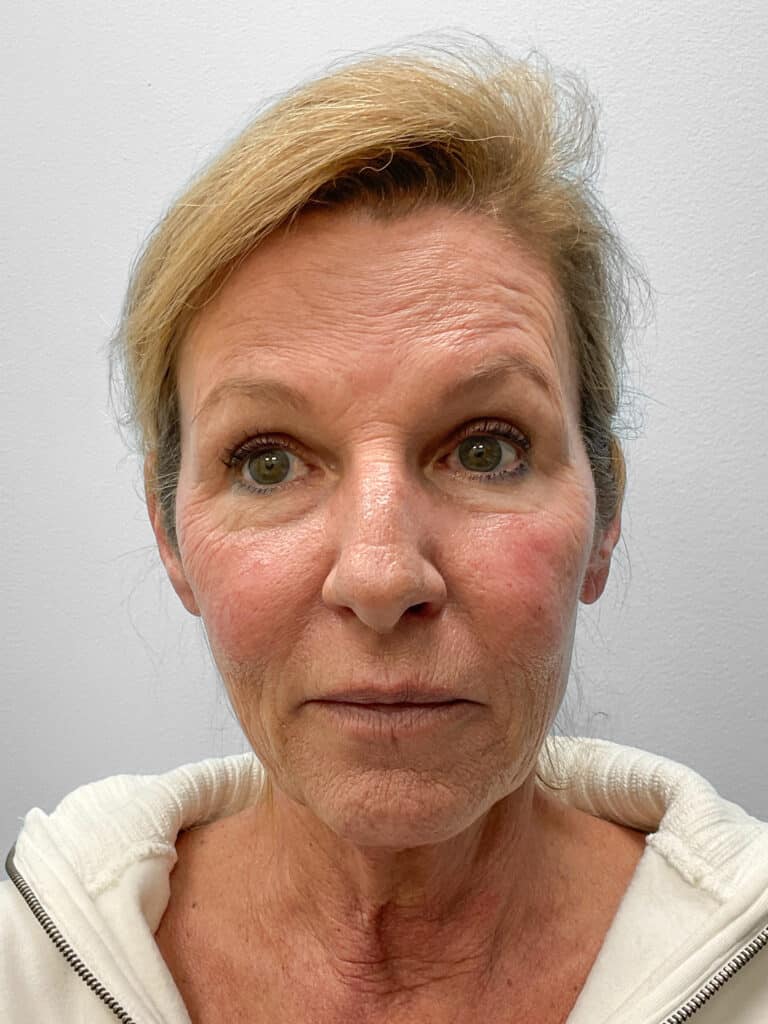 Before Image: Laser Resurfacing – Dr. Tucker - front
