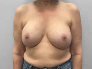 Before Image: Breast Implant Exchange – Dr. Tucker