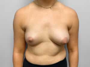 Before Image: Breast Augmentation – Dr. Tucker