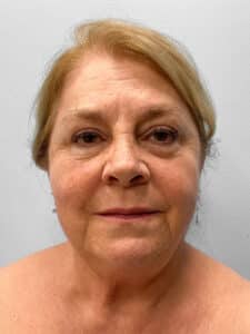 Before Image: Facelift & Laser Resurfacing – Dr. Tucker