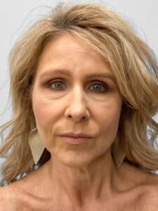 Before Image: Rhinoplasty – Dr. Tucker