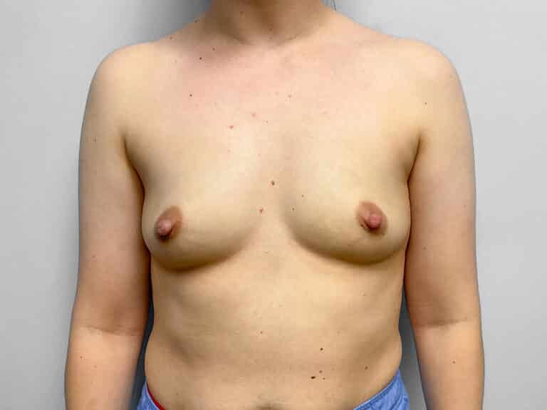 Before Image: Breast Augmentation – Dr. Tucker - front