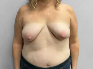 Before Image: Breast Augmentation & Lift – Dr. Tucker