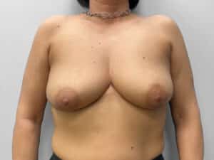 Before Image: Breast Augmentation & Lift – Dr. Tucker