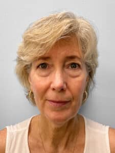 Before Image: Facelift & Blepharoplasty – Dr. Tucker