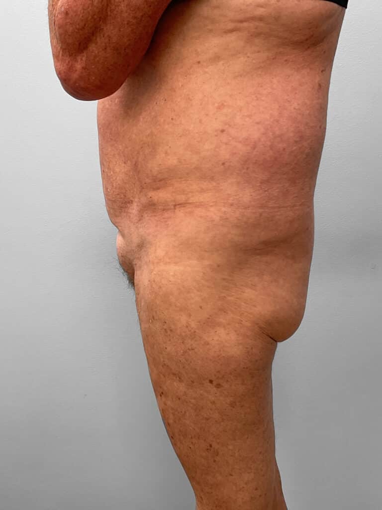Before Image: BBL & Lipo – Dr. Tucker - left-side