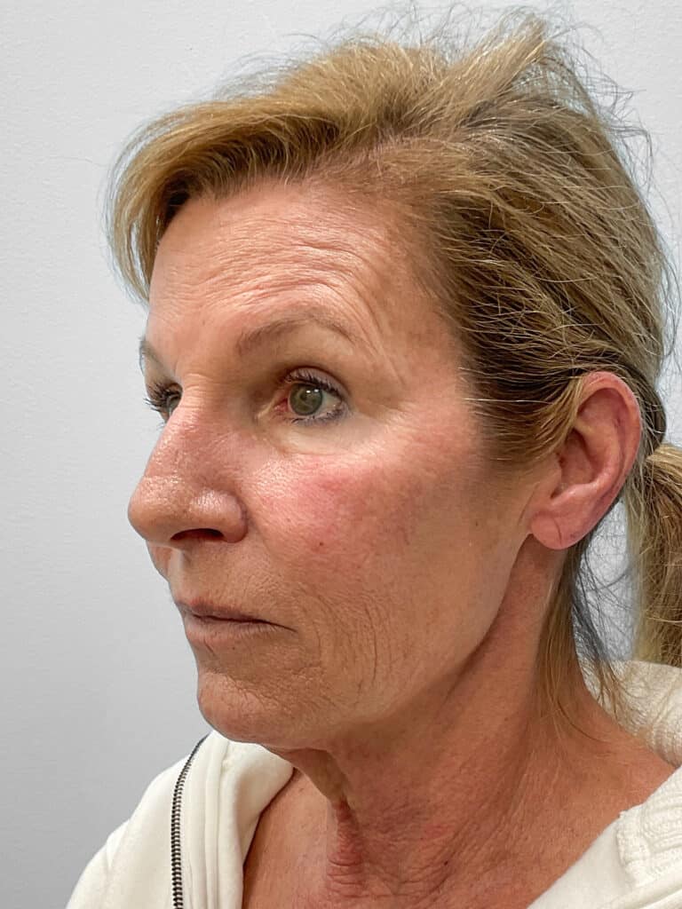 Before Image: Laser Resurfacing – Dr. Tucker - left-front-oblique