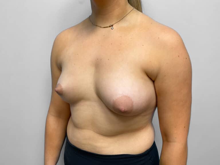 Before Image: Breast Augmentation – Dr. Tucker - left-front-oblique