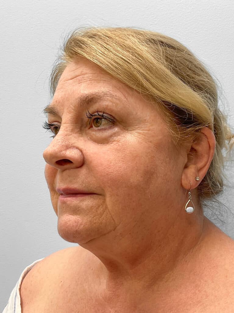 Before Image: Facelift & Laser Resurfacing – Dr. Tucker - left-front-oblique