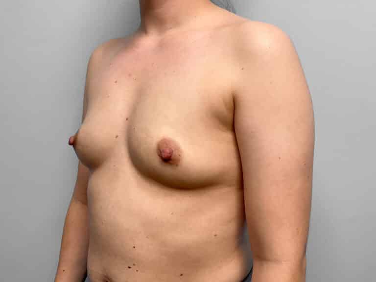 Before Image: Breast Augmentation – Dr. Tucker - left-front-oblique