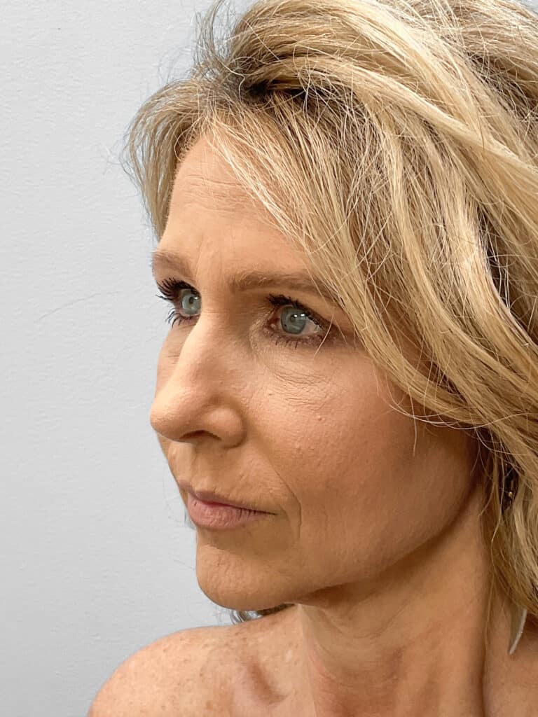 Before Image: Rhinoplasty – Dr. Tucker - left-front-oblique