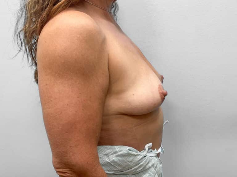 Before Image: Breast Augmentation – Dr. Tucker - right-side
