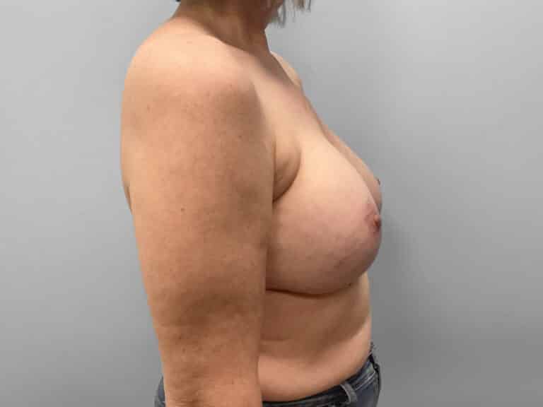 Before Image: Breast Implant Exchange – Dr. Tucker - right-side