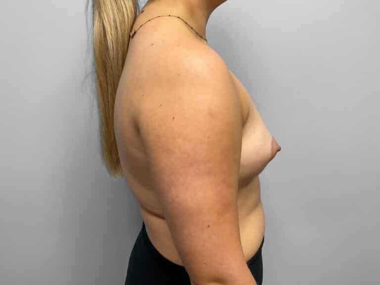 Before Image: Breast Augmentation – Dr. Tucker - right-side