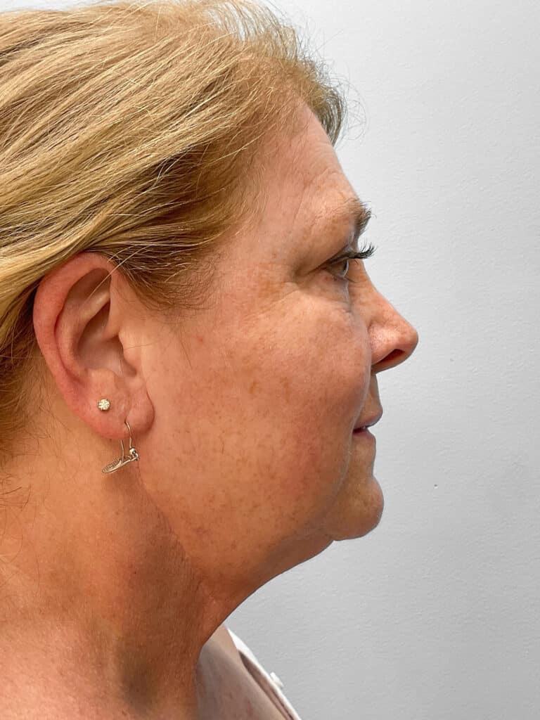 Before Image: Facelift & Laser Resurfacing – Dr. Tucker - right-side