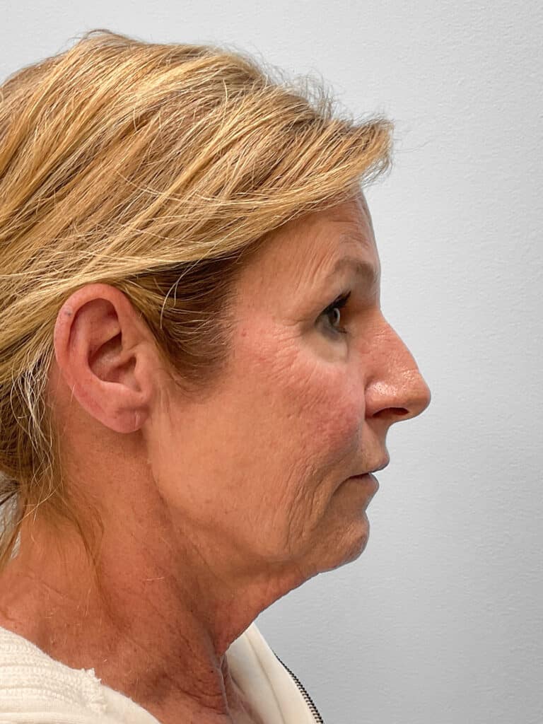 Before Image: Laser Resurfacing – Dr. Tucker - right-side