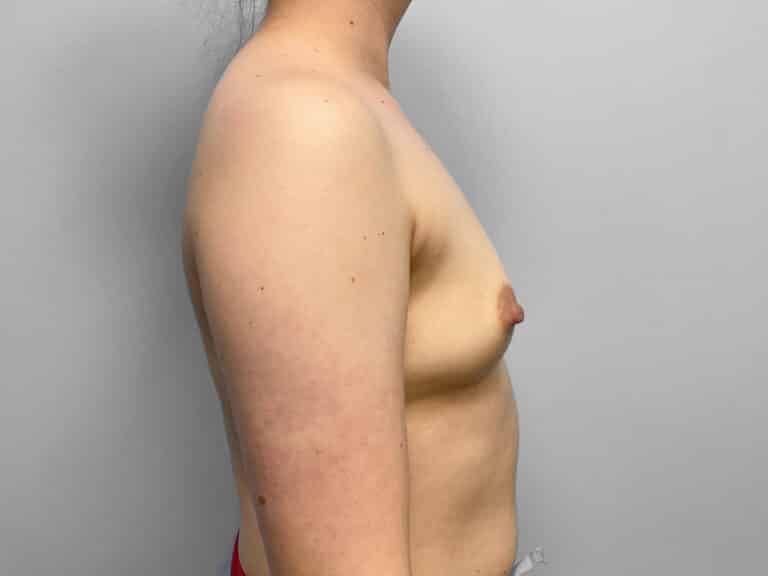 Before Image: Breast Augmentation – Dr. Tucker - right-side