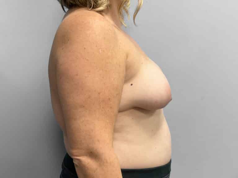 Before Image: Breast Augmentation & Lift – Dr. Tucker - right-side