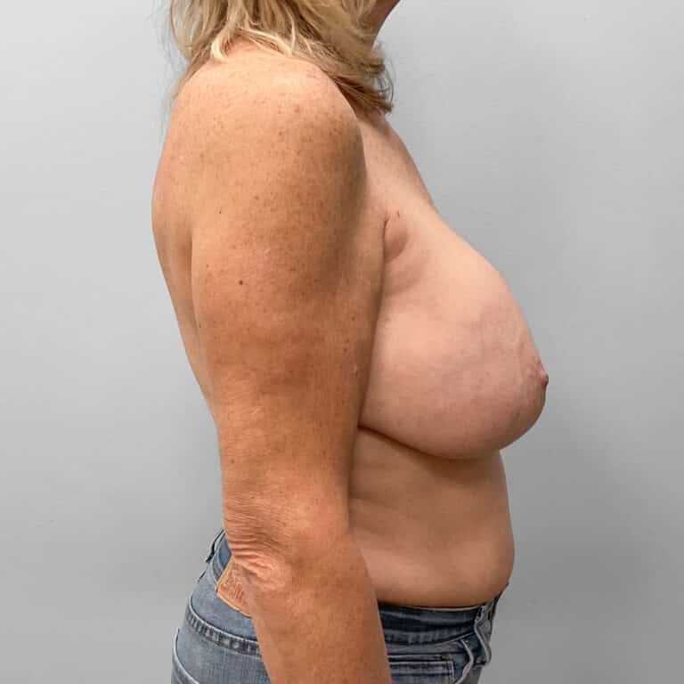 Before Image: Breast Implant Removal & Lift – Dr. Tucker - right-side