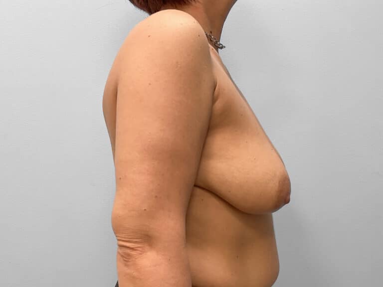 Before Image: Breast Augmentation & Lift – Dr. Tucker - right-side