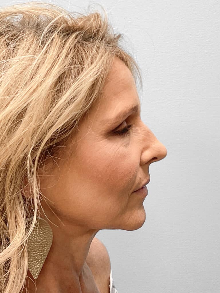 Before Image: Rhinoplasty – Dr. Tucker -