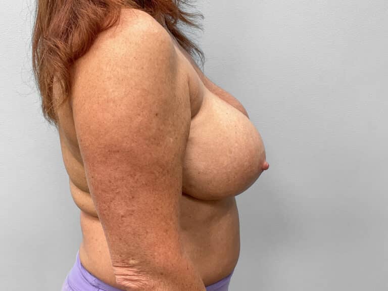 Before Image: Breast Implant Exchange – Dr. Tucker - right-side