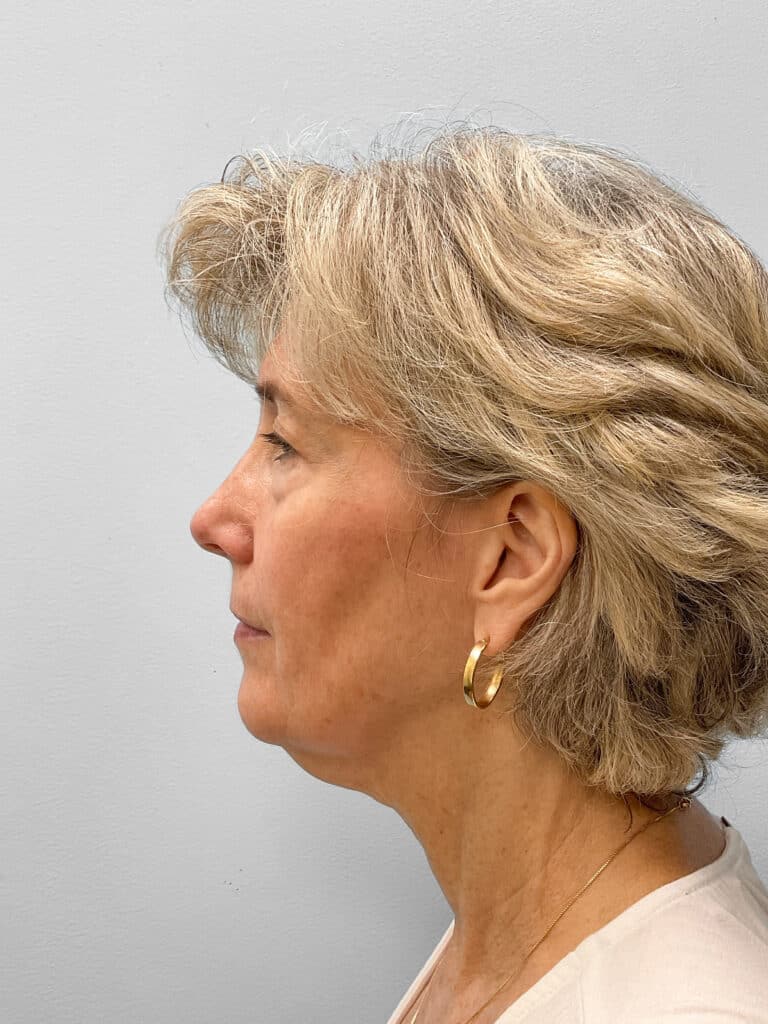Before Image: Facelift & Blepharoplasty – Dr. Tucker - left-side