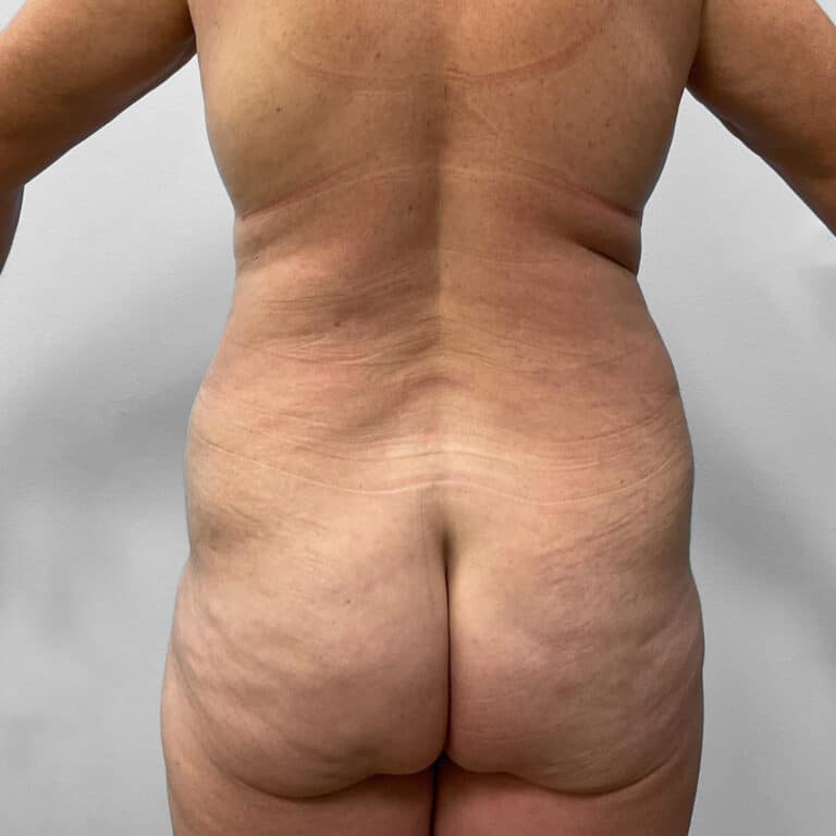 After Image: Tummy Tuck & Lipo – Dr. Tucker - back