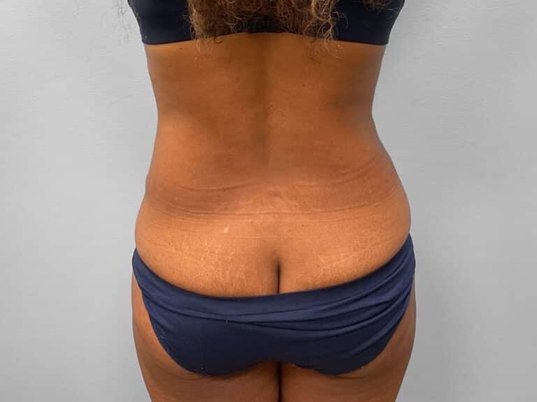 After Image: Tummy Tuck & Lipo – Dr. Tucker - back
