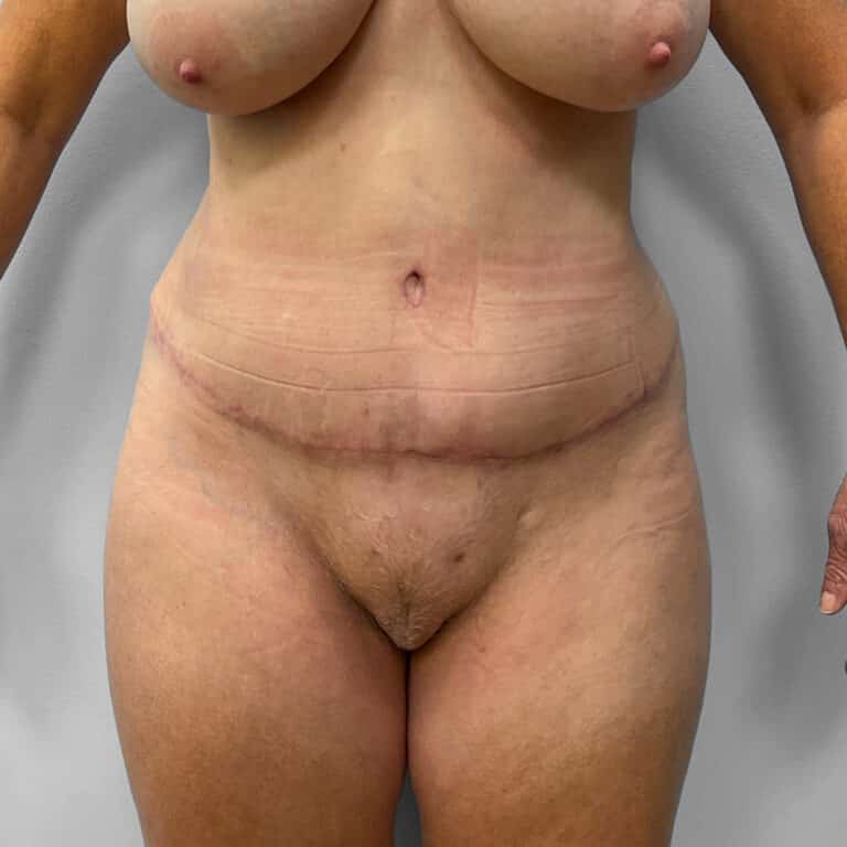 After Image: Tummy Tuck & Lipo – Dr. Tucker - front