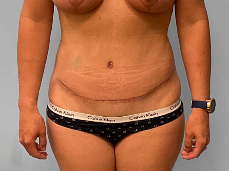 After Image: Tummy Tuck – Dr. Tucker - front