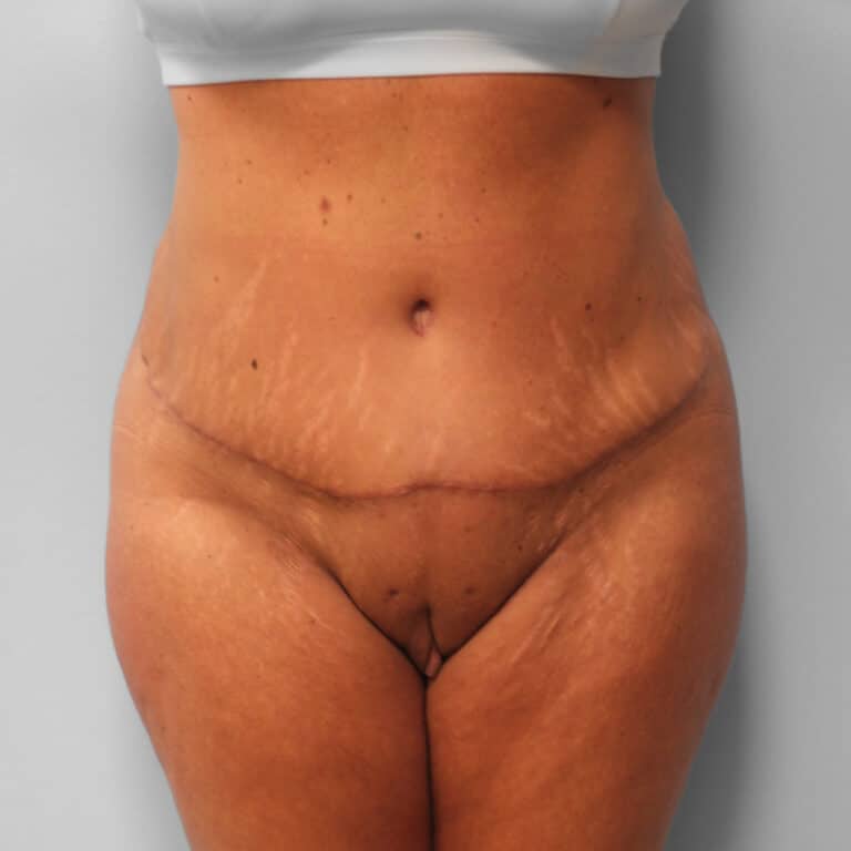After Image: Tummy Tuck & Lipo – Dr. Tucker - front