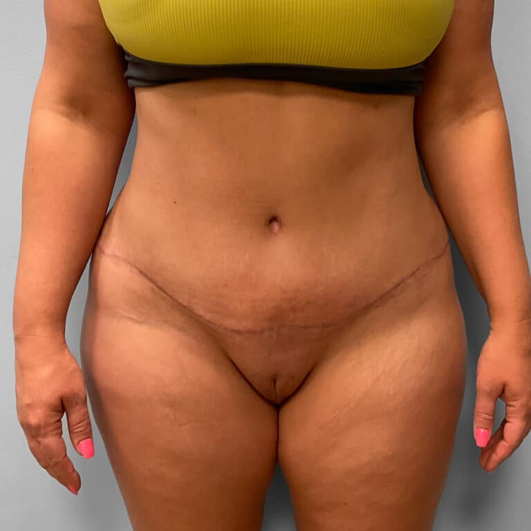 After Image: Abdominoplasty & Lipo – Dr. Tucker - front